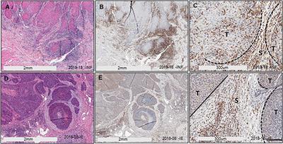 Cytokine profiling in plasma distinguishes the histological inflammatory subtype of head and neck squamous cell carcinoma and a novel regulatory role of osteopontin